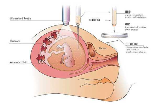 到香港验血费用多少,宫腔积液如何影响辅助生殖技术中助孕过程？